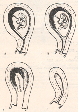 Определение понятия, виды и классификация абортов