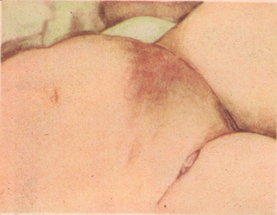 Генерализованная послеродовая инфекция: общий перитонит; септицемия; септикопиемия; пиемия; послеродовые тромбофлебиты