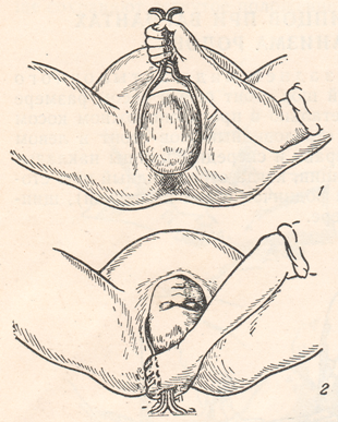 Техника наложения щипцов при вариантах основного механизма родов